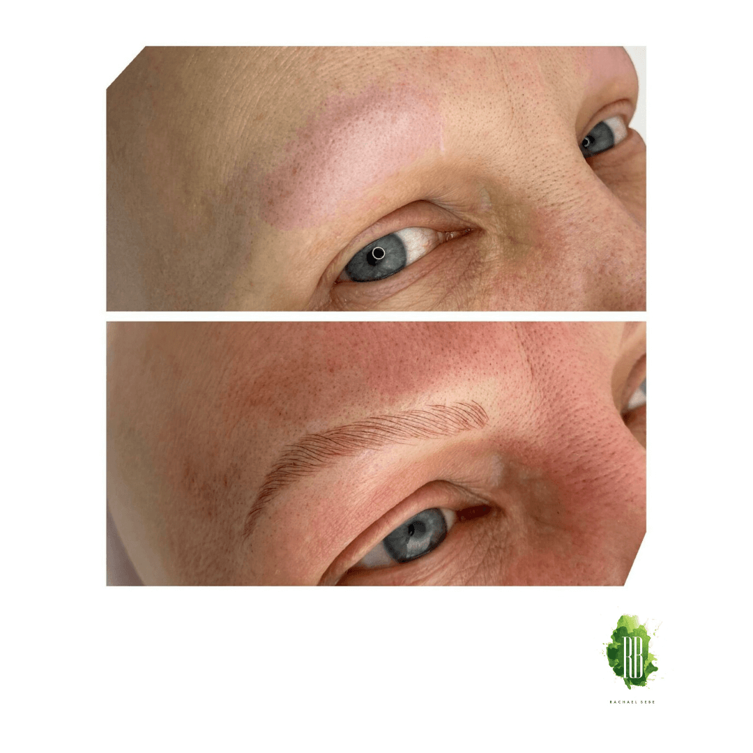 Cosmetic Tattoo Microblading on Alopecia Skin by Rachael Bebe (complimentary Service)